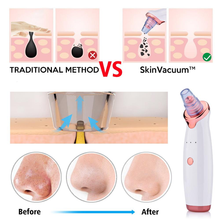 Load image into Gallery viewer, The Skin Vacuum - World's #1 Blackhead Remover